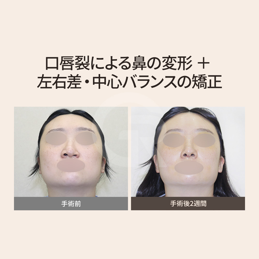 韓国ギリン美容外科による口唇口蓋裂鼻整形の術前術後比較。