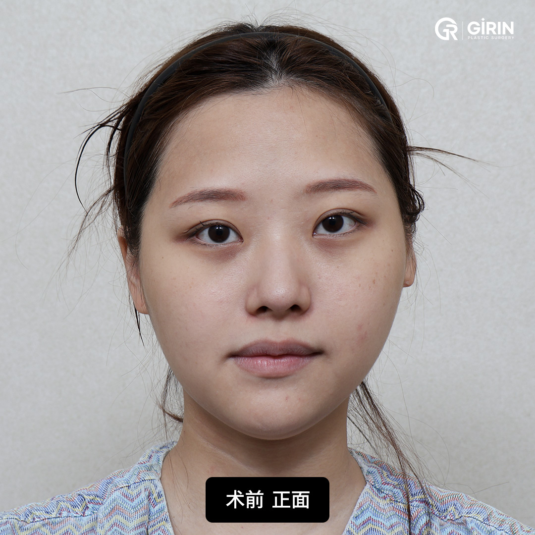 精准矫正面部不对称和咬合