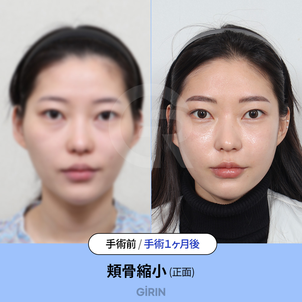 前頬骨と側頬骨のバランス調整が自然さの鍵。