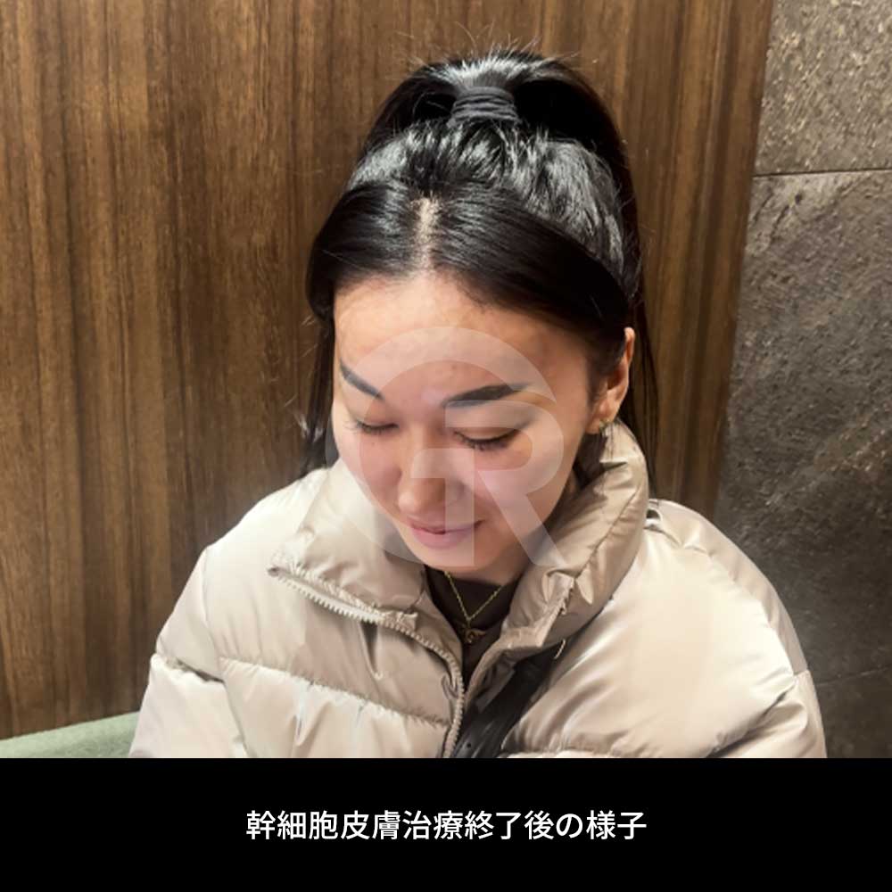 スキンブースターと幹細胞治療の選択は、肌に必要なのが維持か再生かによって異なります。