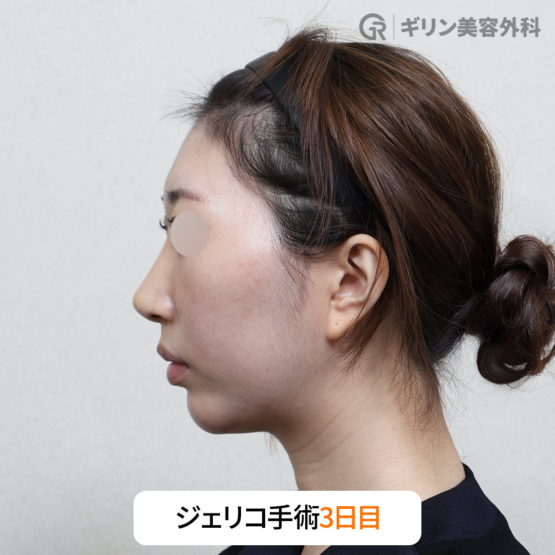 わずか数日で腫れが引き、傷跡が目立たない回復プロセス