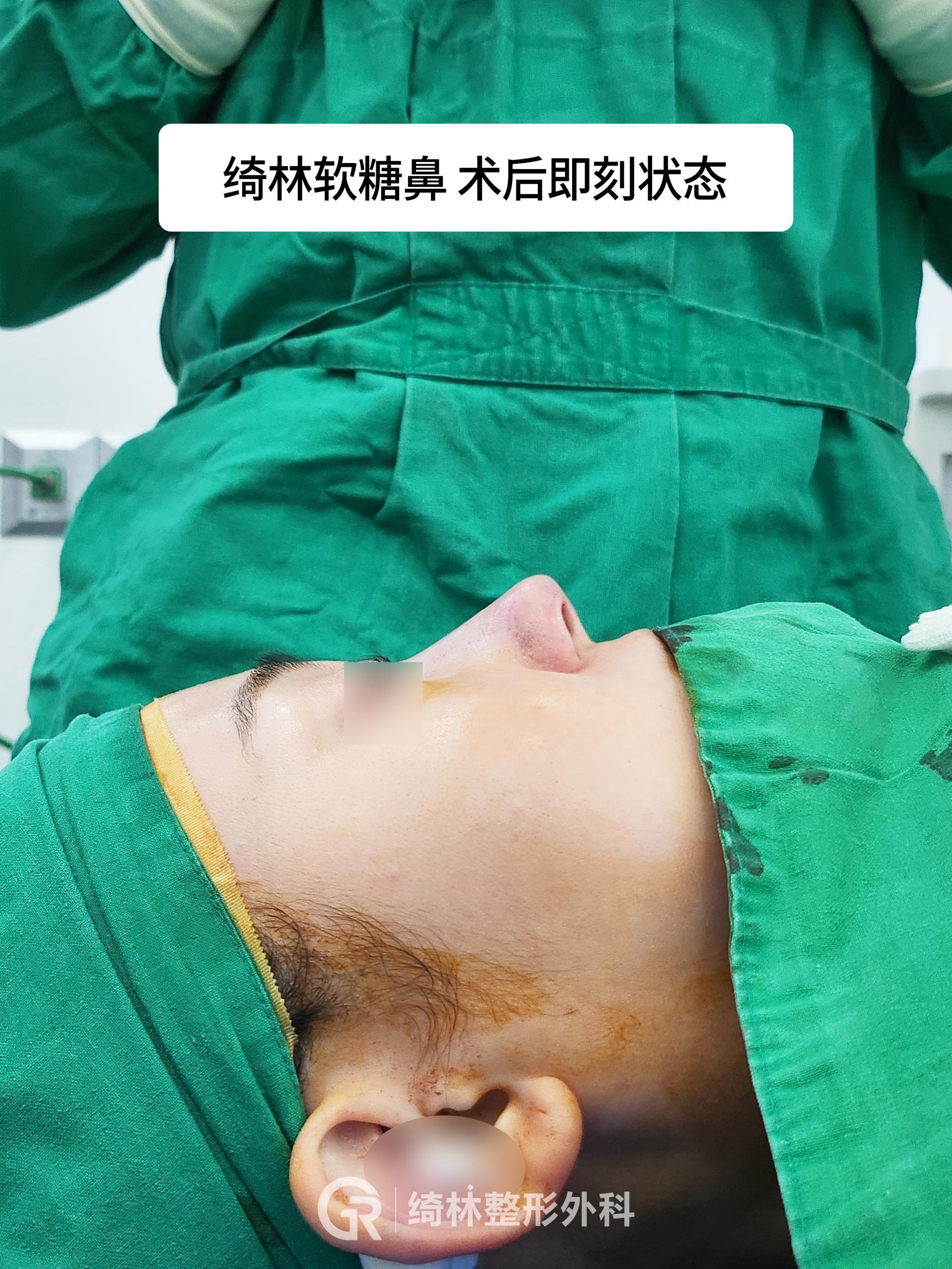 术后仅轻度贴胶带，3天内即可恢复正常生活。