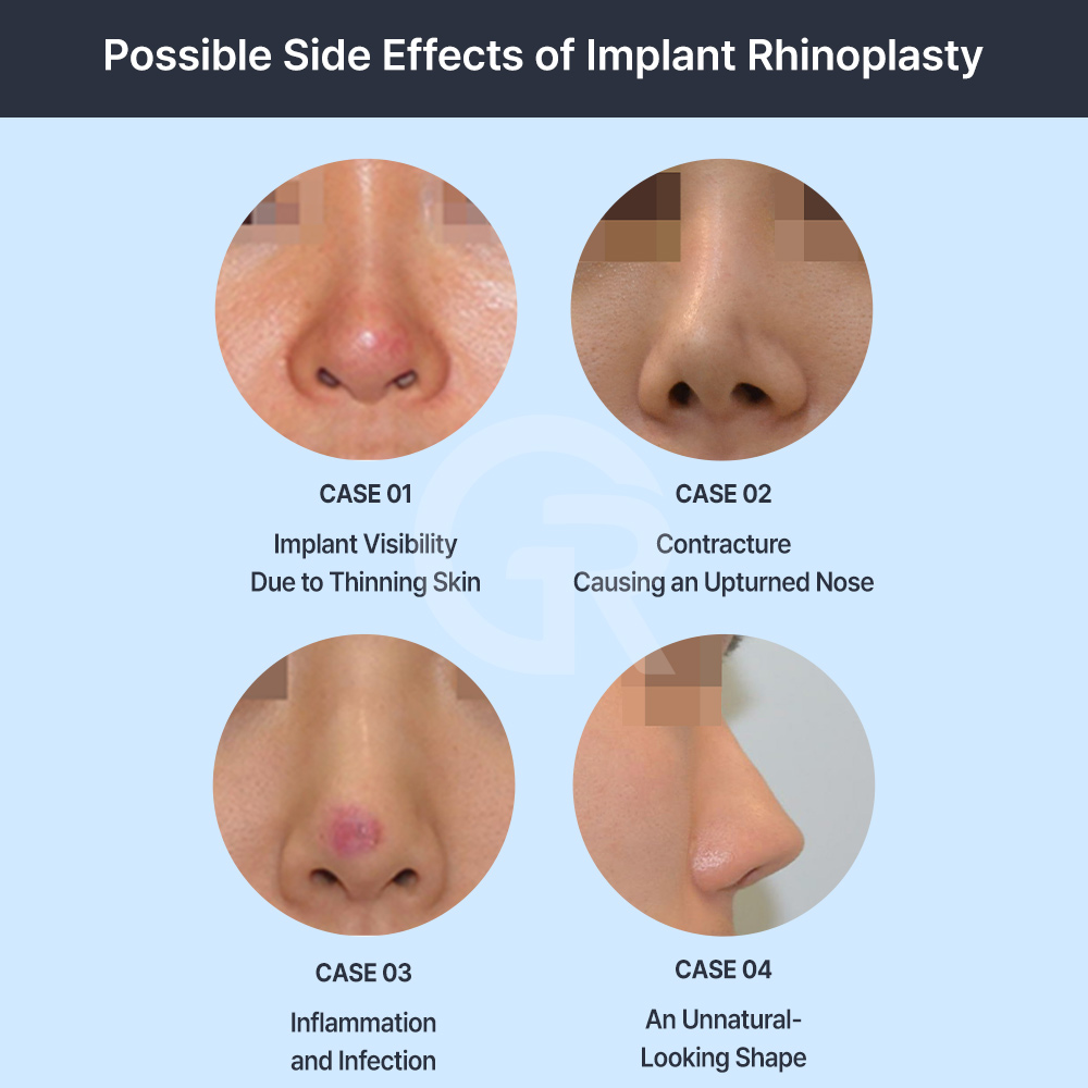 Implant-free rhinoplasty focuses on creating a natural nasal line that suits the face.