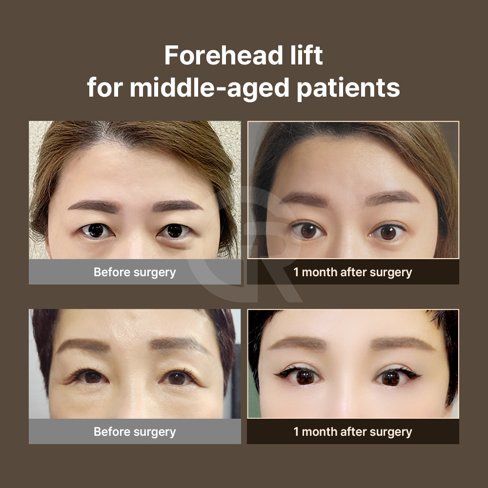 Sub-brow lift corrects eyebrow descent without significantly changing the eyelid crease.