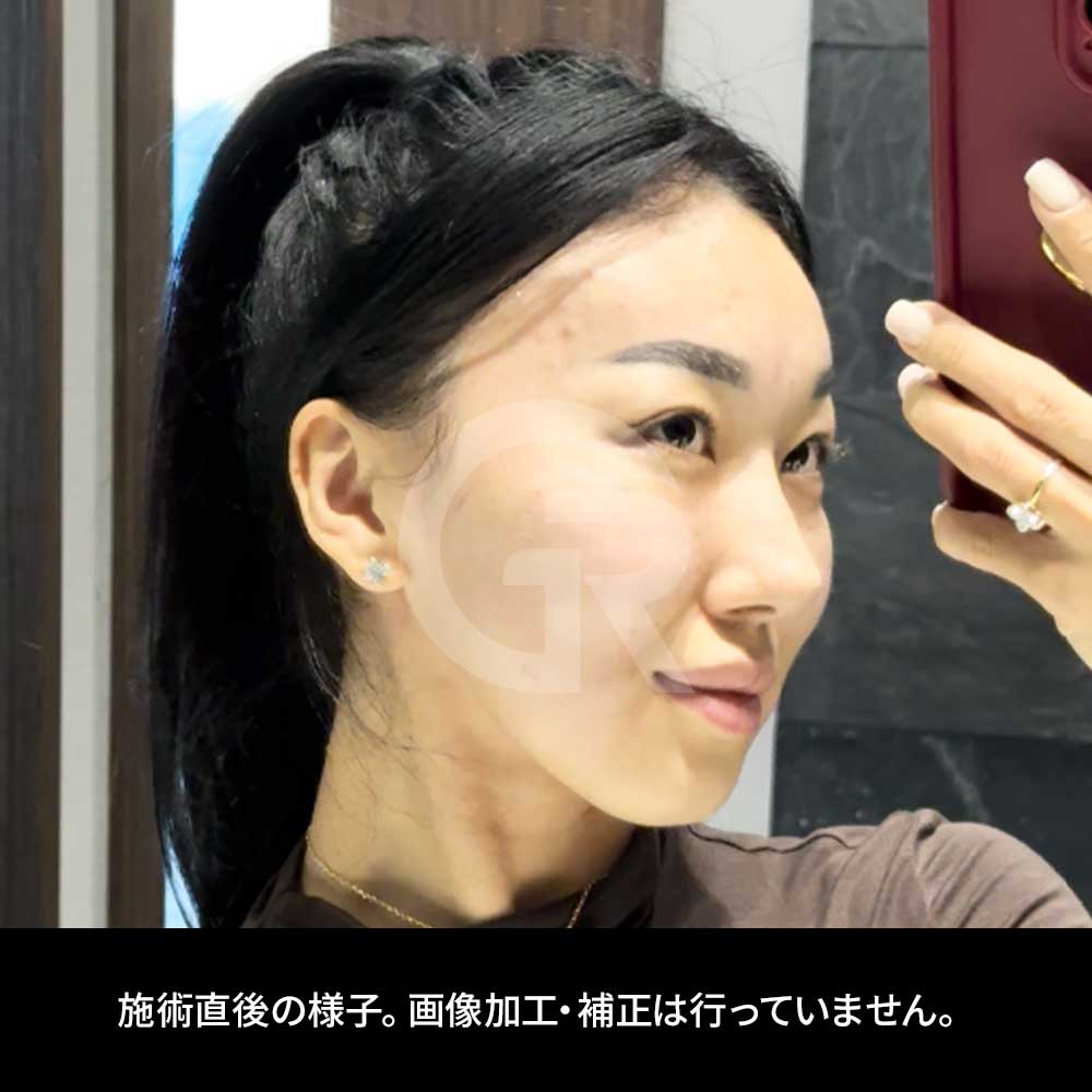 スキンブースター注射は、スキンケアでは補いきれない水分補給や肌質改善を目的として行われます。
