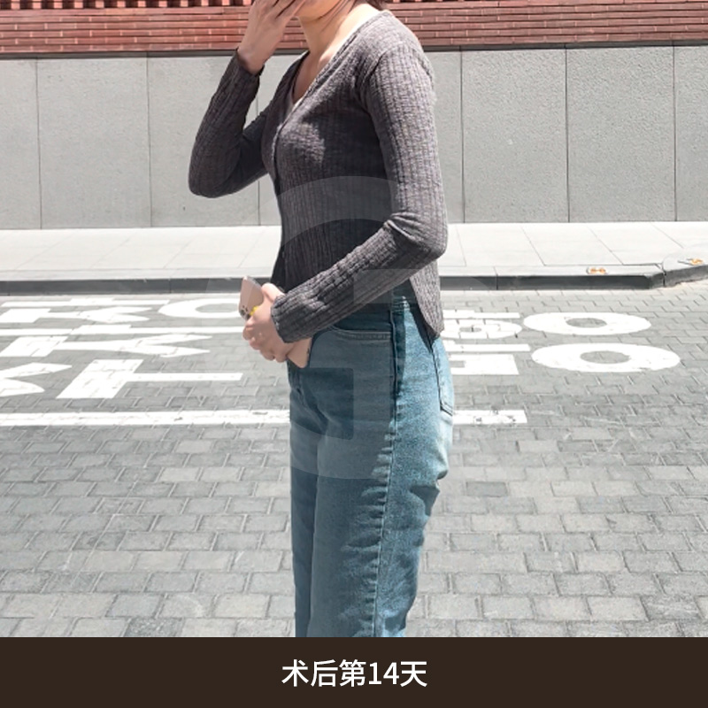 Upper arm contour gradually improves over several months after the procedure.