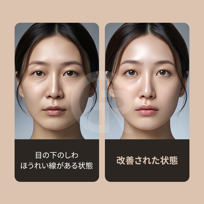 目の下・頬・ほうれい線を一つの構造として引き上げます。