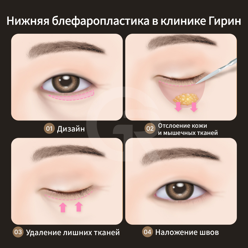 Thermage стимулирует выработку коллагена и повышает упругость кожи вокруг глаз.