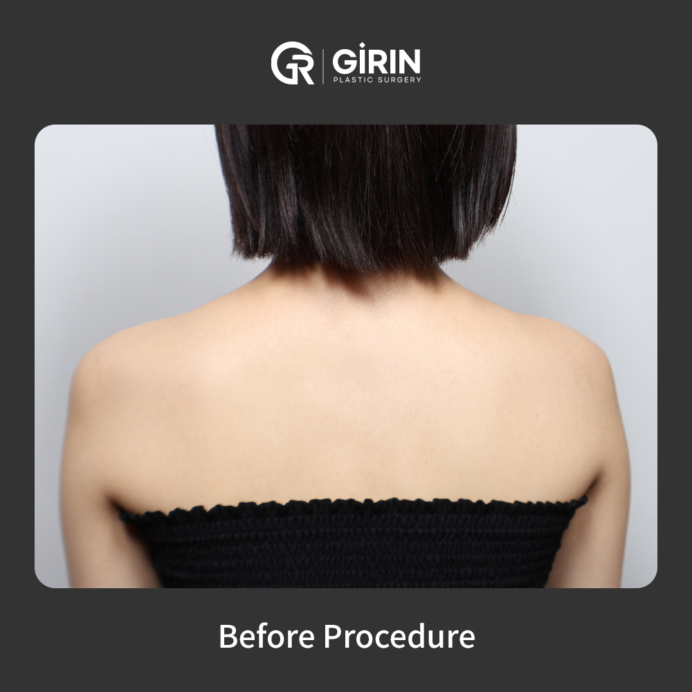 Enhance your shoulder contour with filler – no surgery, no downtime
