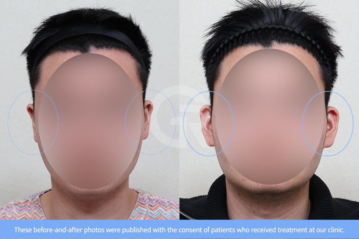 Before and after ear reshaping surgery demonstrating improved ear angle and natural ear contour.