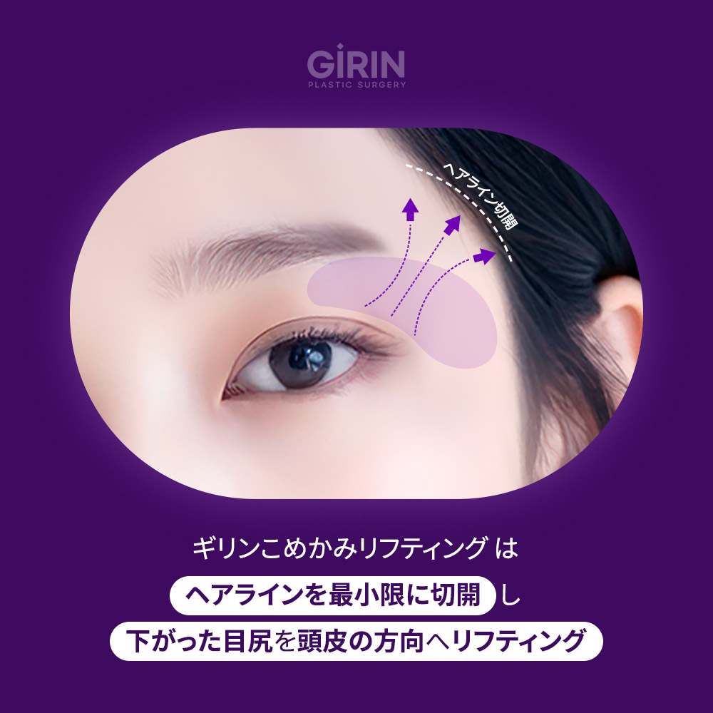 こめかみリフトで筋膜に固定し、長期的な効果を実現。
