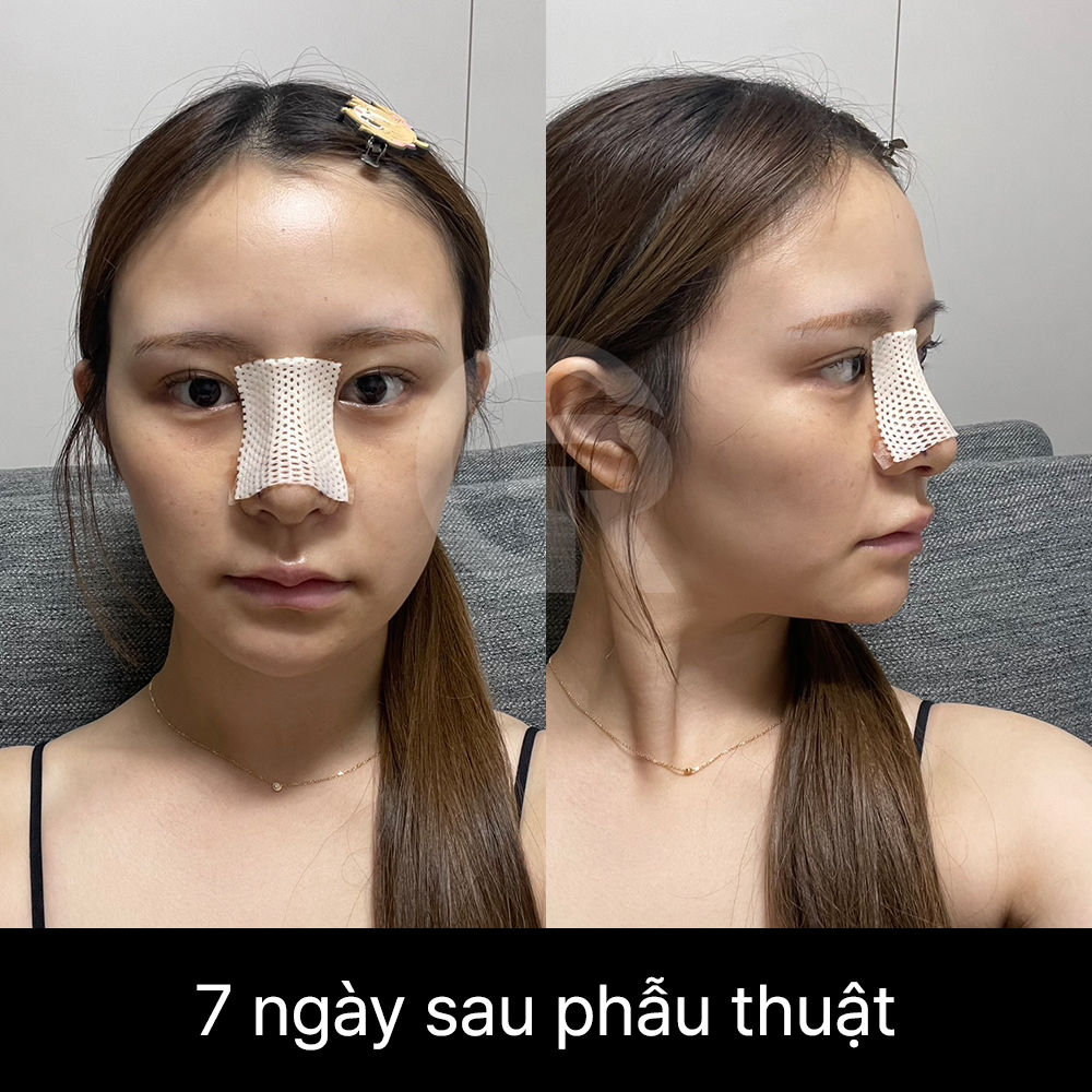 Chỉnh sửa mũi đầu to không phải là làm đầu mũi thật nhọn, mà là tinh chỉnh dáng mũi trong khi vẫn giữ độ mềm mại tự nhiên.
