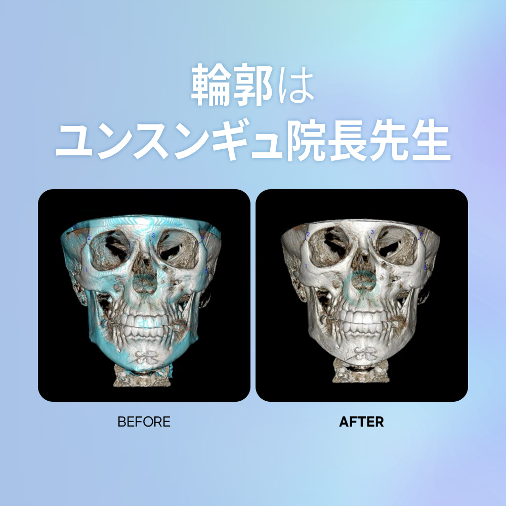 ギリン整形外科｜輪郭整形ビフォーアフター症例。