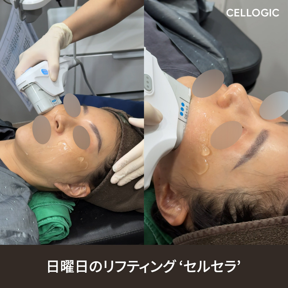 韓国でのウルセラ（Ultherapy Prime）は正規機器を使用し、安全性と安定したリフティング効果を重視しています。