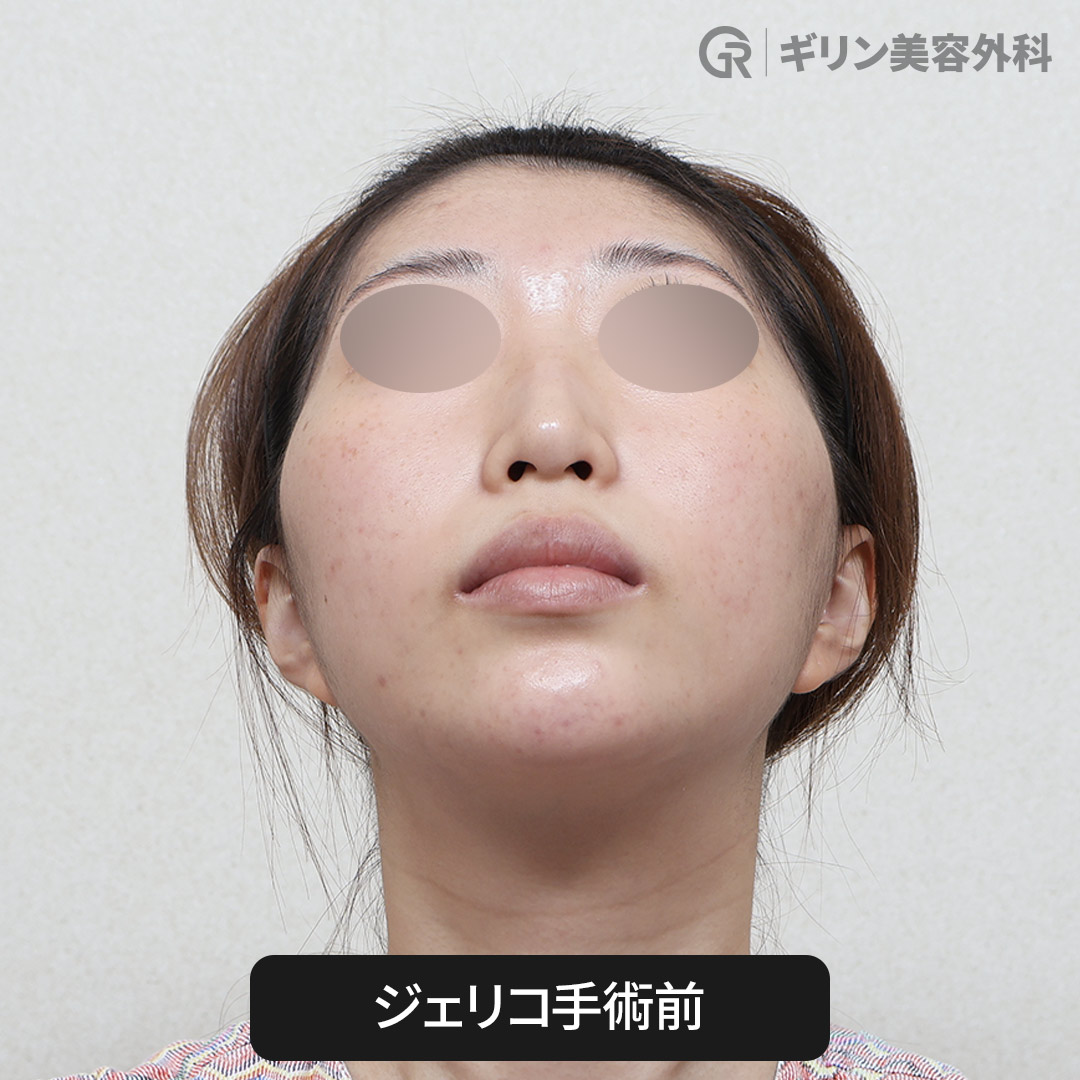 自然で美しい鼻筋 ― 韓国の切開なし技術で実現
