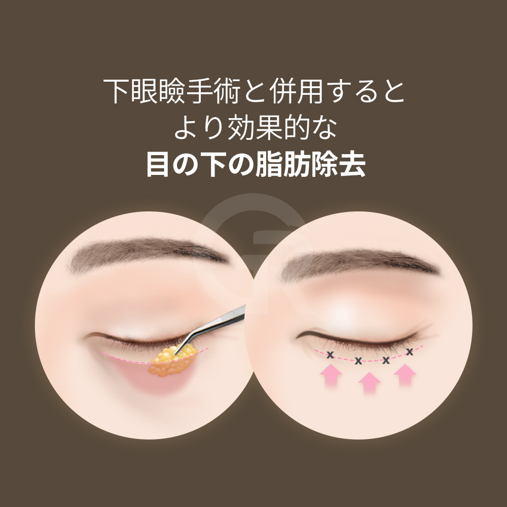 手で眉を持ち上げることで、原因が眉にあるかを確認できます。