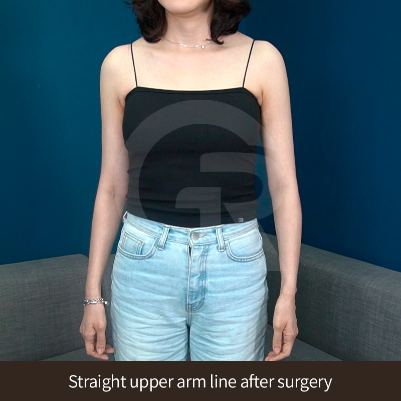 Upper arm liposuction is often considered when exercise and diet fail to change arm contours.