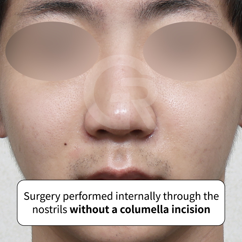Structural correction of a hump nose using implant-free Jellyko rhinoplasty performed at GIRIN PLASTIC SURGERY in Korea.