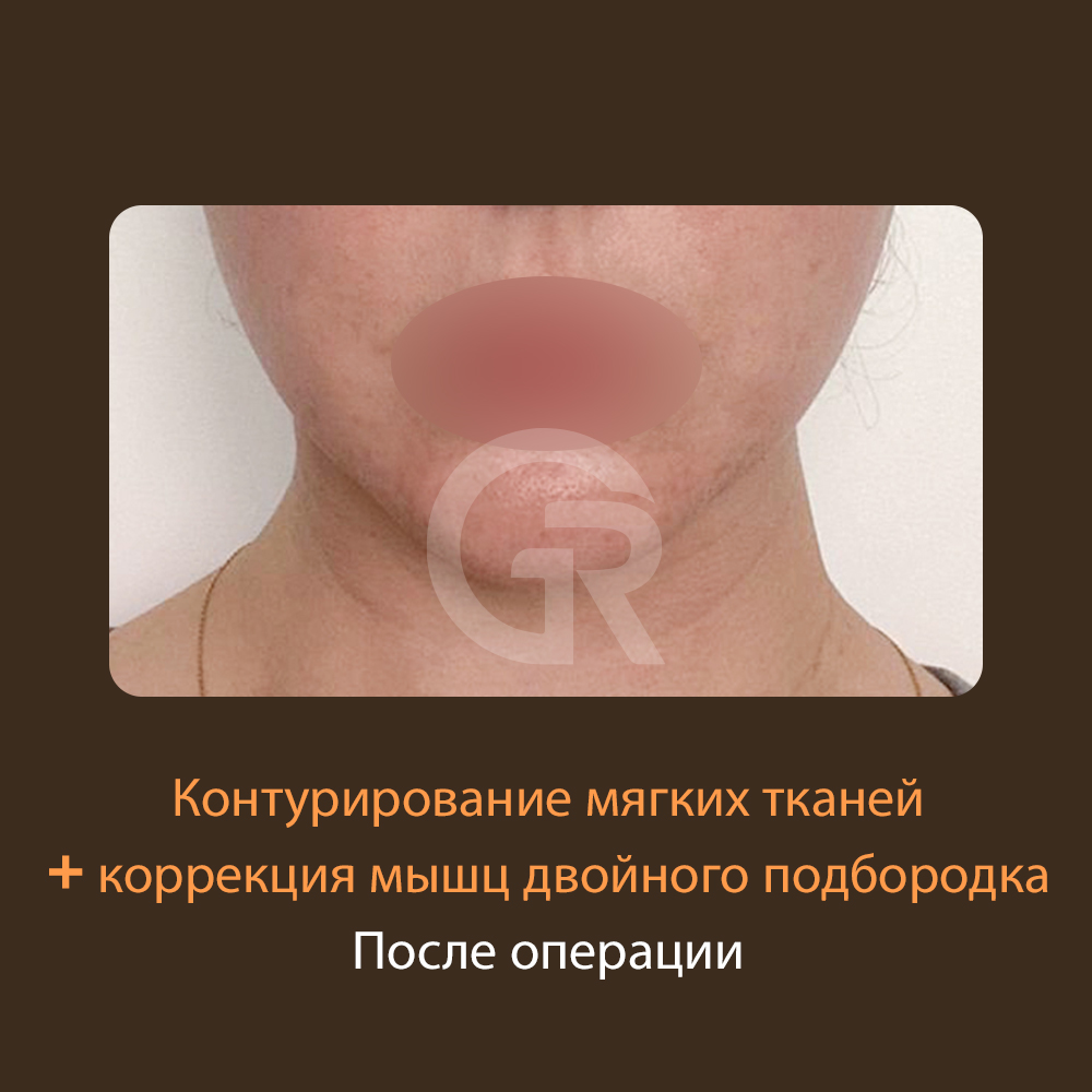 Если вас беспокоят второй подбородок и провисание лица, важно оценивать не только внешний вид, но и структурные причины размытости линии.