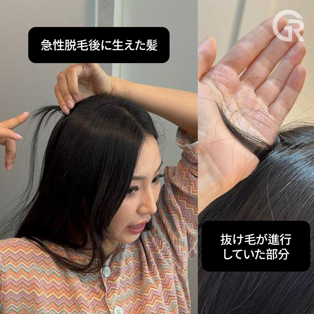 20代女性の初期脱毛症状の一例