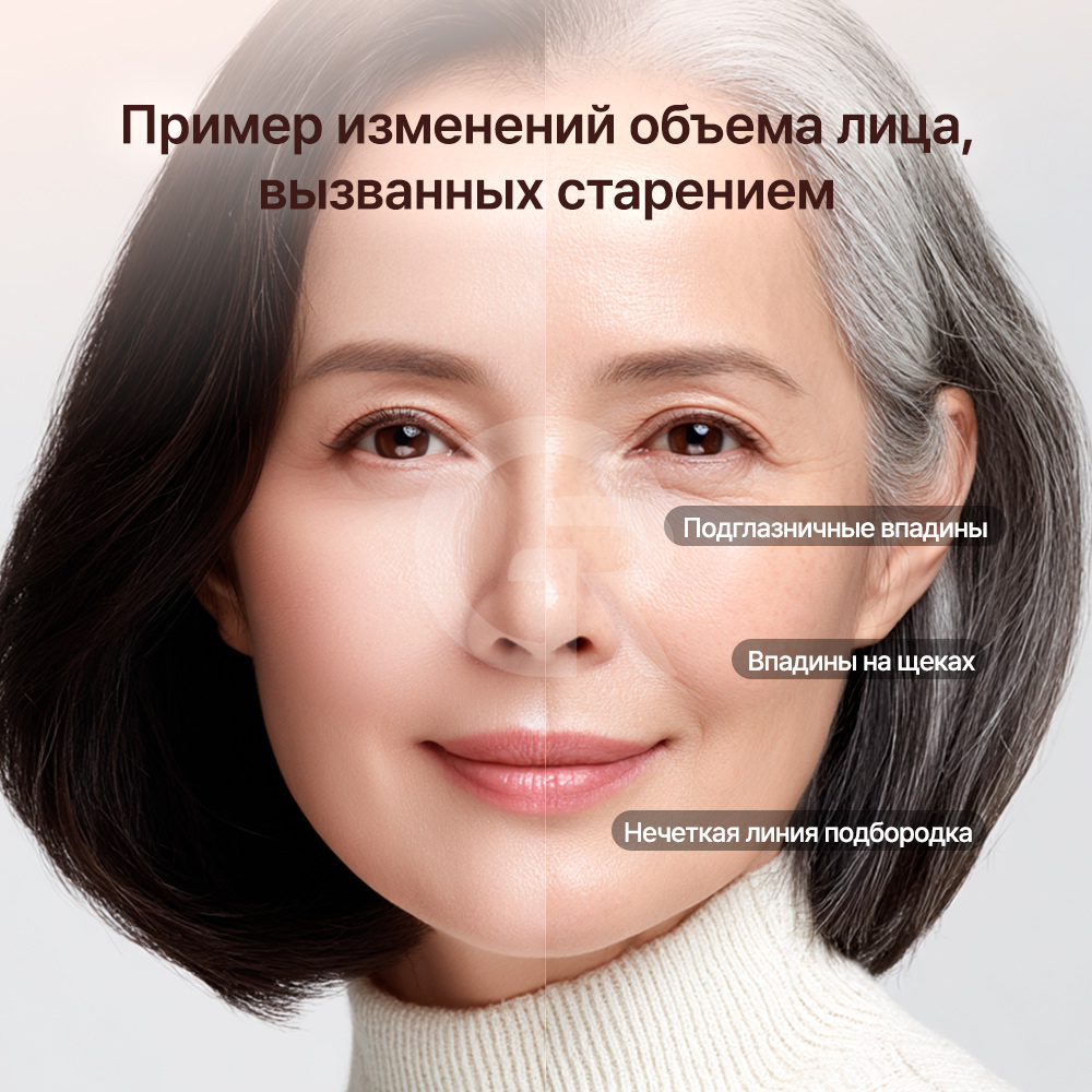 При аутологичном липофилинге используется собственный жир пациента, поэтому риск аллергии и реакции на инородный материал относительно ниже.
