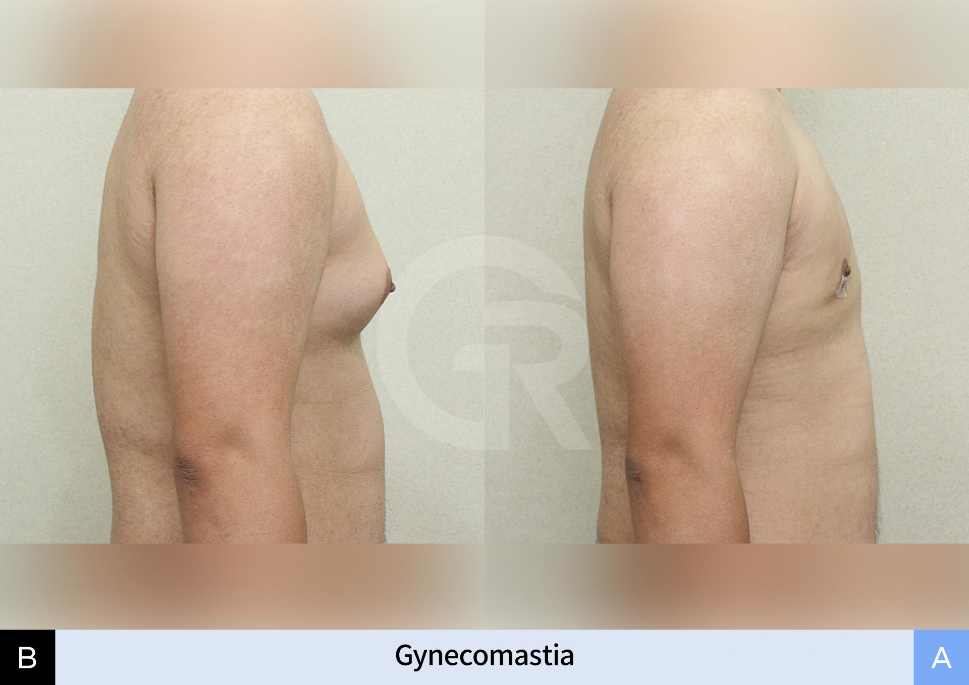 gynecomastia-before-after-korea.jpg (2).jpg