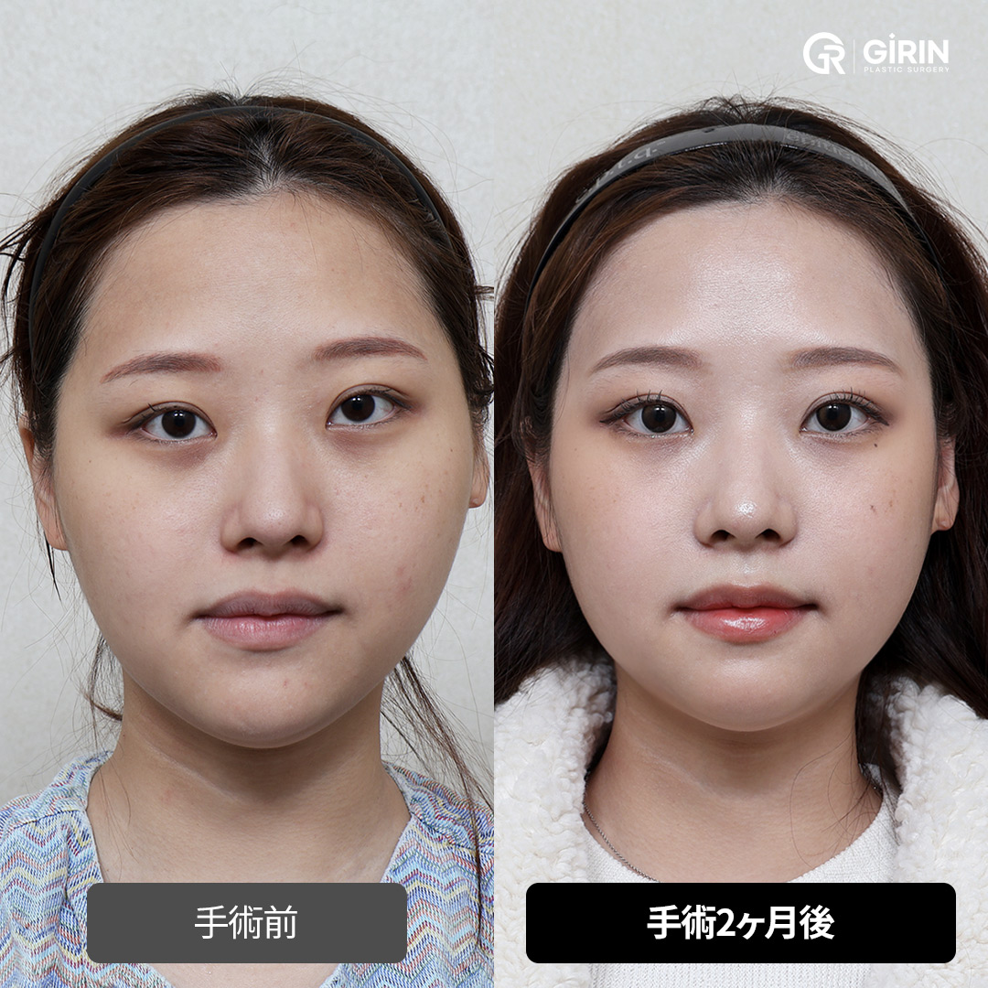 SSRO手術後のバランスの取れたフェイスライン