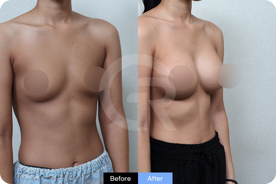Girin Plastic Surgery Korea Breast Augmentation case 01 Half Side