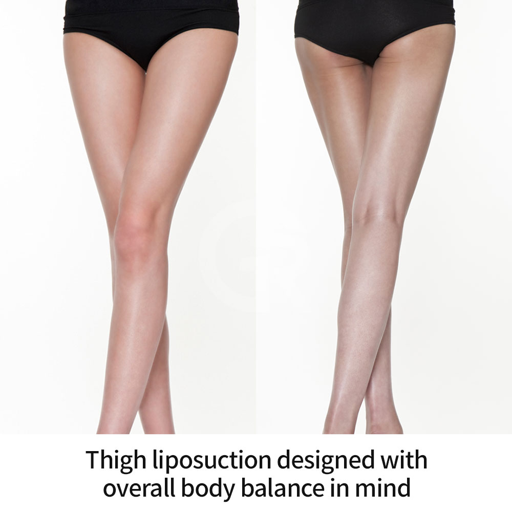 For people who are slim but lower-body heavy, thigh liposuction requires a precise and conservative approach.