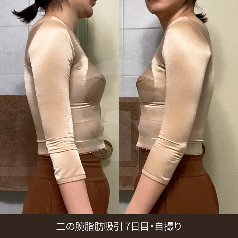二の腕脂肪吸引と二の腕リフトの違いを比較
