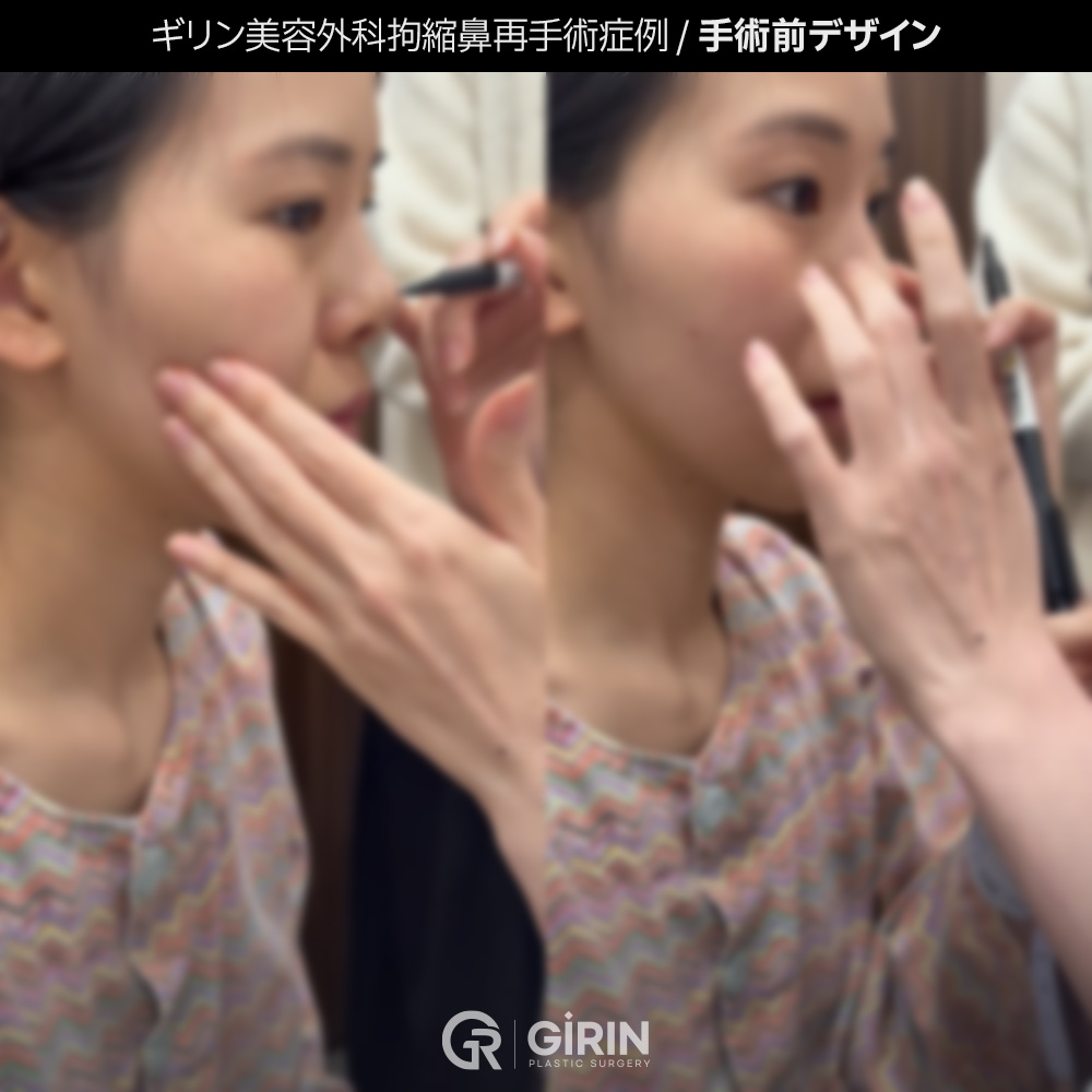 韓国ギリン整形外科のショートノーズ再手術症例