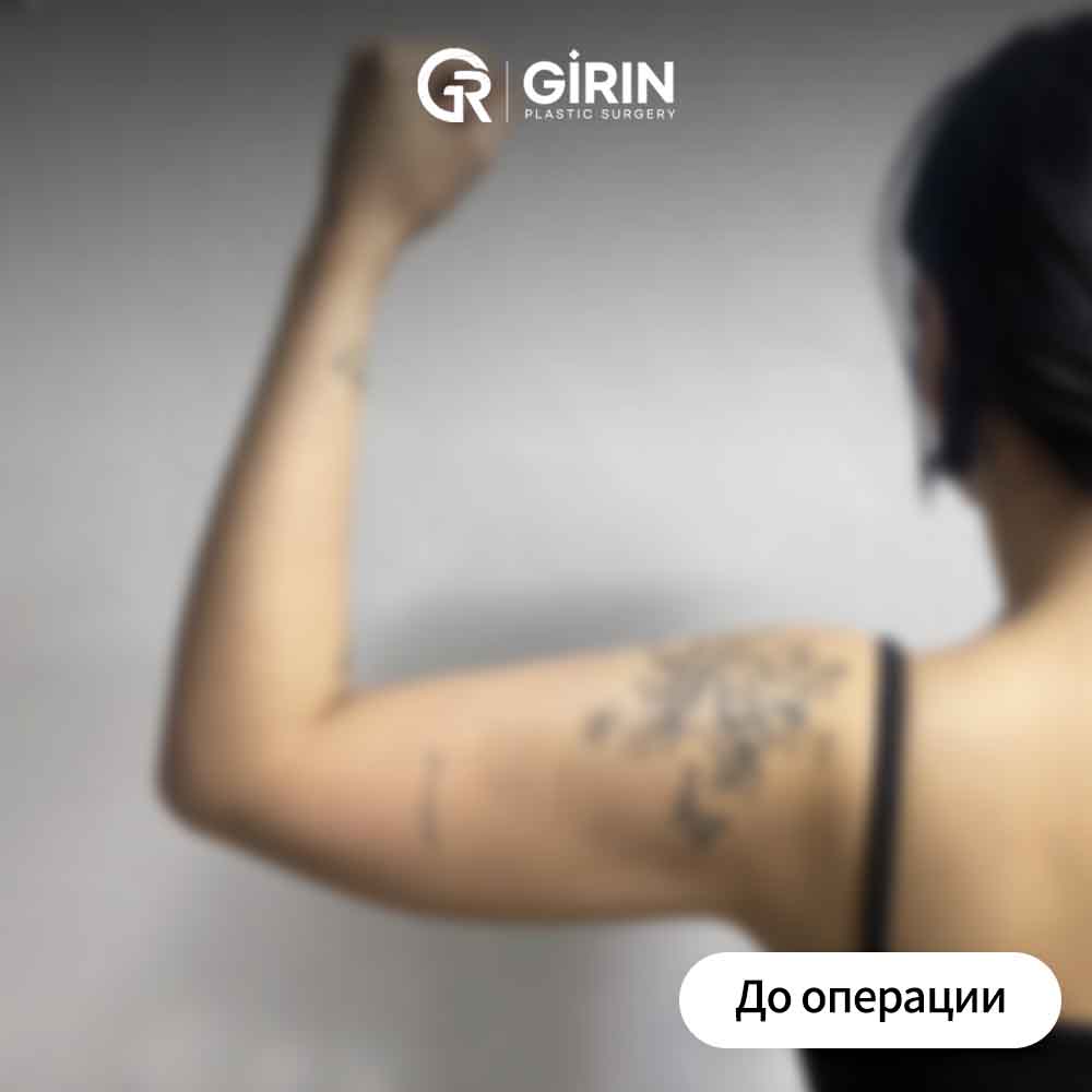 Удаление плотного жира с зоны рук – пример пациента