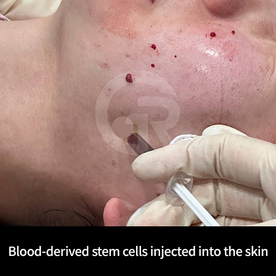 Structural skin improvement occurs gradually through collagen regeneration.