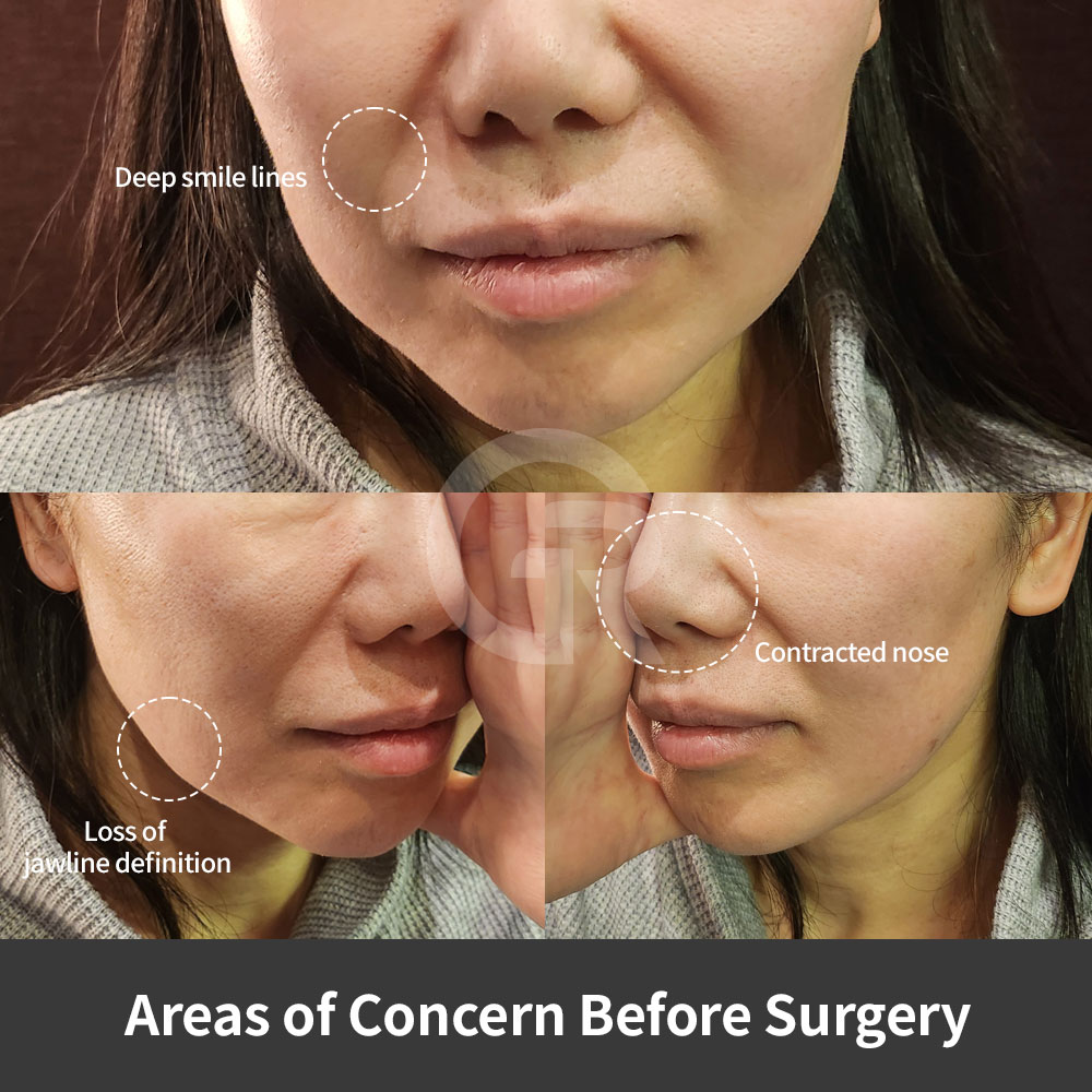 Girin Plastic Surgery in Gangnam, Korea, offers anti-aging plastic surgery including mini facelift, wrinkle correction, and lower-face sagging improvement.