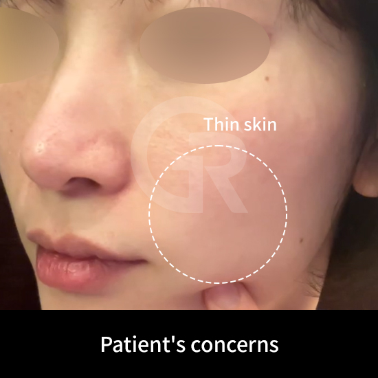 In thin skin, pores tend to appear elongated due to reduced structural support.