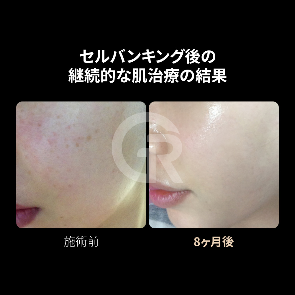 幹細胞は再生医療において、皮膚再生やアンチエイジングなど幅広く活用されています。