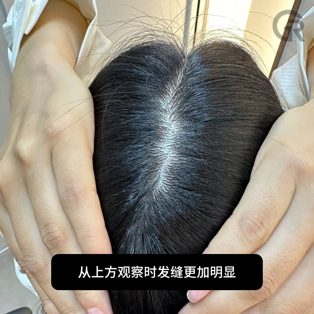 M型发际线逐渐明显的情况