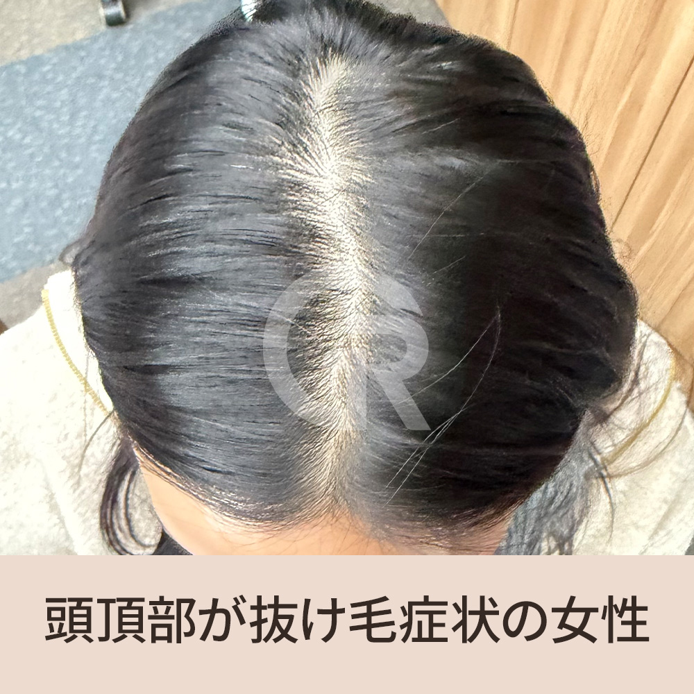 薄毛は単に髪の毛が抜ける問題ではなく、気づかないうちに進行している頭皮環境の悪化が本当の原因となっている可能性があります