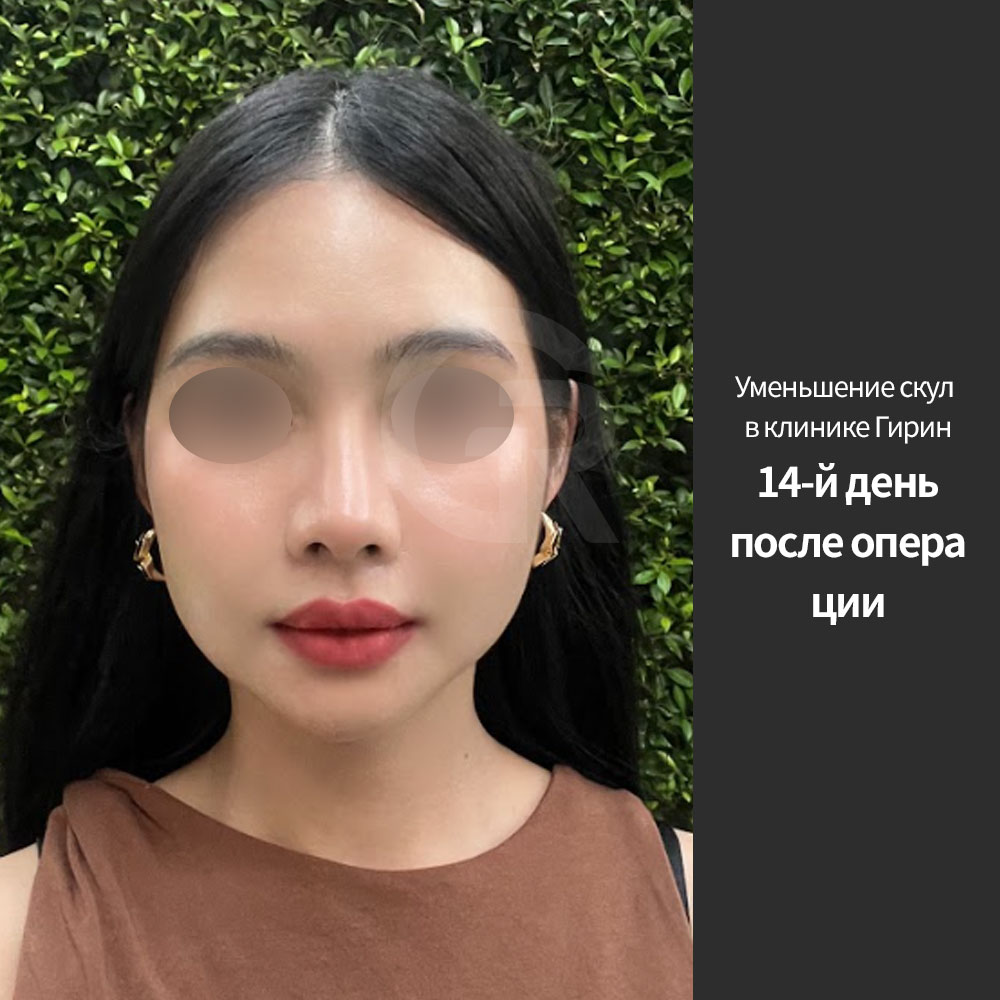 Контурная пластика лица должна планироваться с учетом костной структуры, толщины кожи, объема щек и симметрии лица.