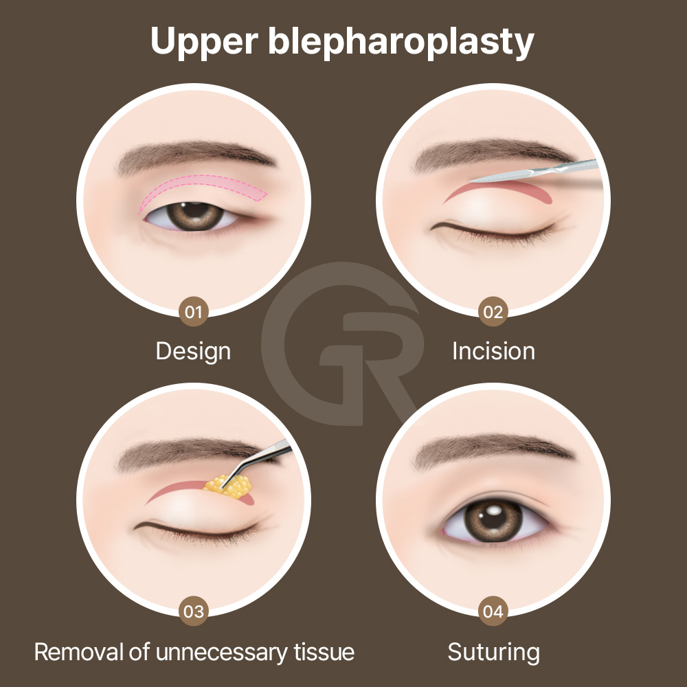Understanding the difference between brow lift and blepharoplasty is essential for choosing the right approach.