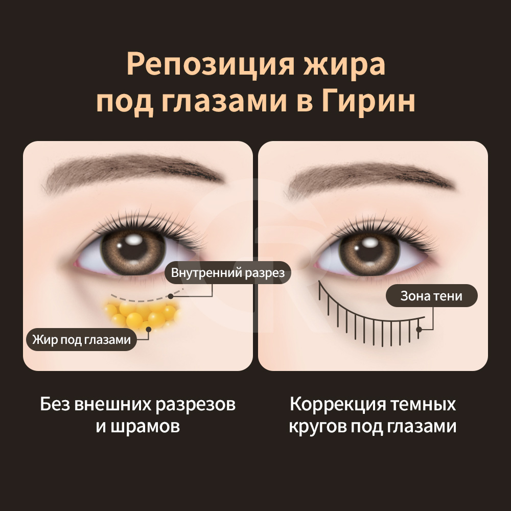Трансконъюнктивальный доступ не оставляет видимых внешних рубцов.