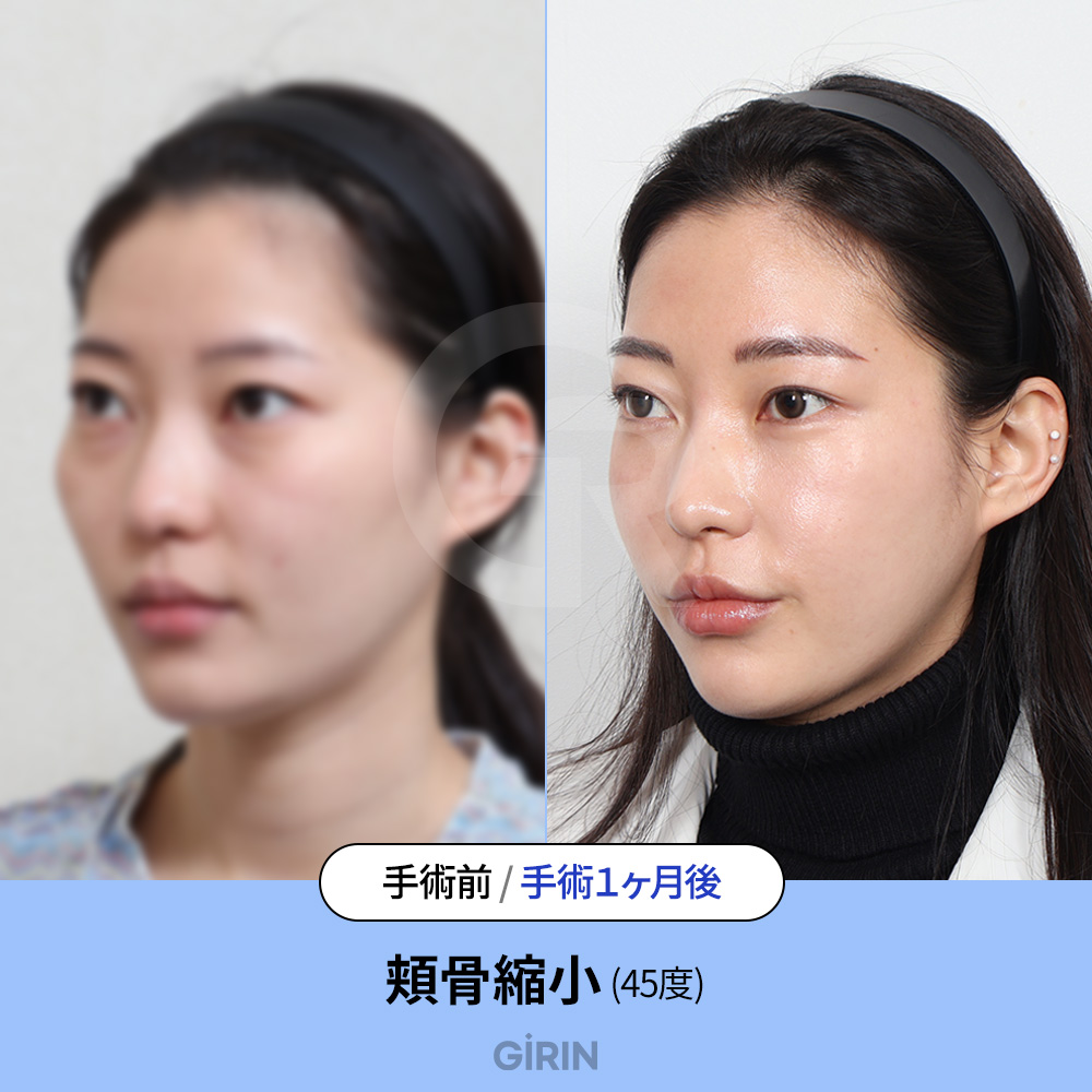 非対称は左右別々の角度調整で丁寧に修正。