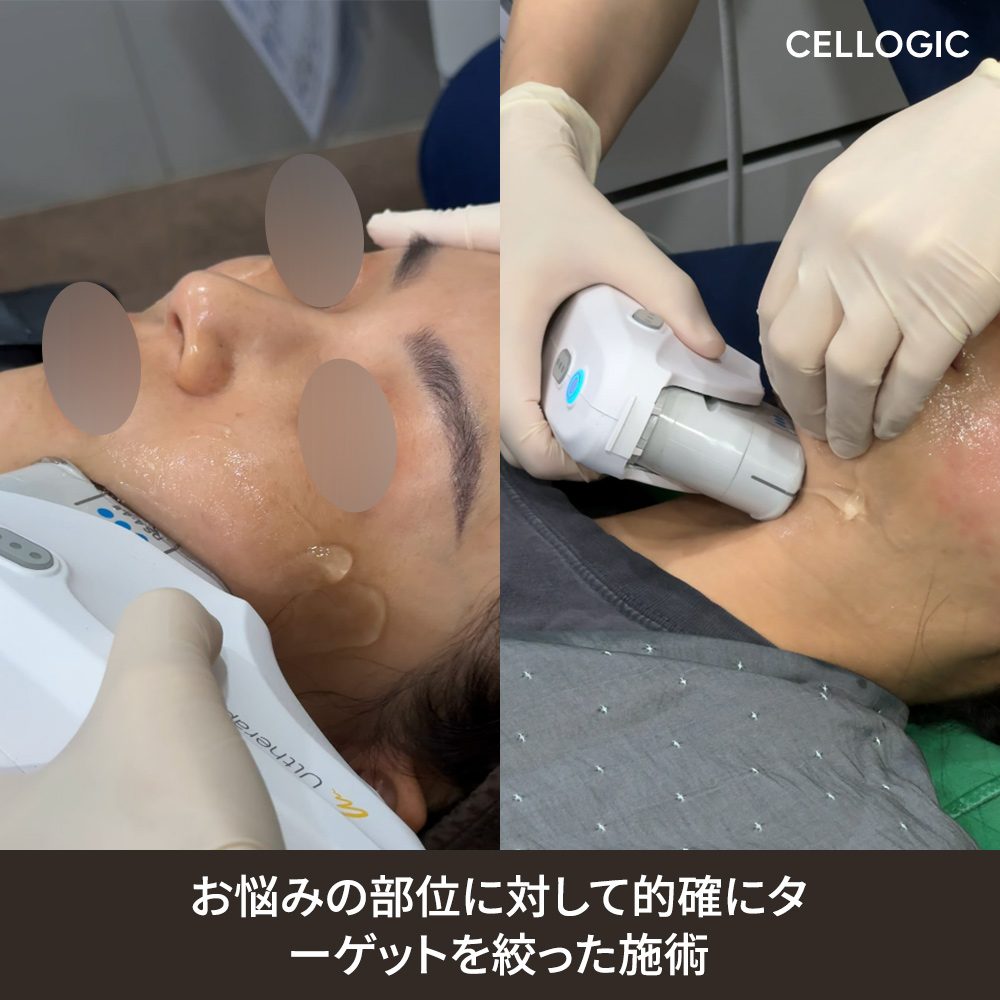 韓国の切らないリフティング施術は、フェイスラインの改善だけでなく自然な仕上がりを重視します。
