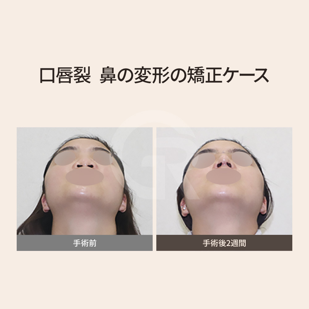 男性口唇口蓋裂鼻整形、自然な仕上がりと構造安定性を重視。