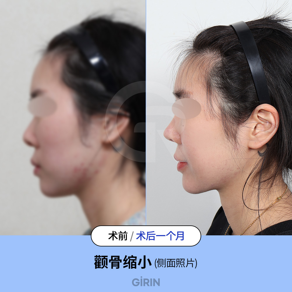 韩国3D颧骨缩小术概论（完整中脸结构指南） : Blog