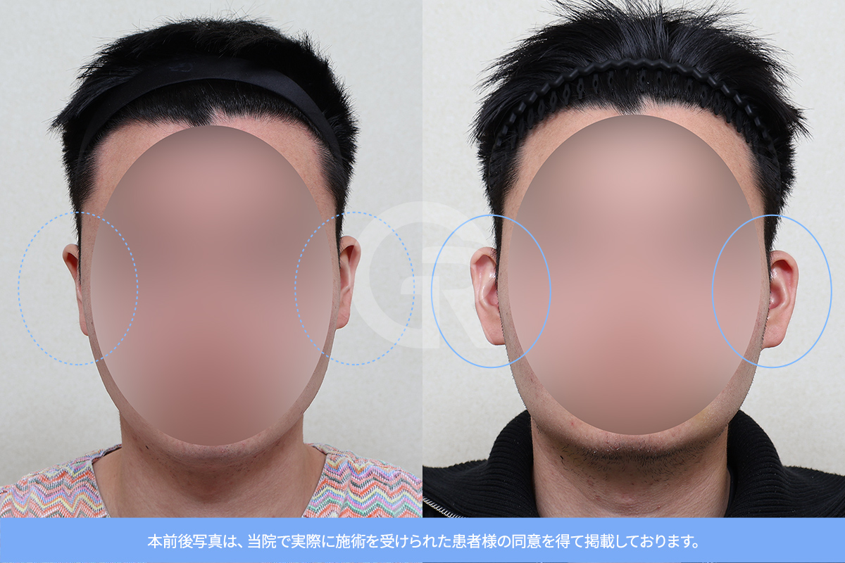 寝た耳は顔が長く見える原因になることがあり、耳整形によってバランスが改善されます。