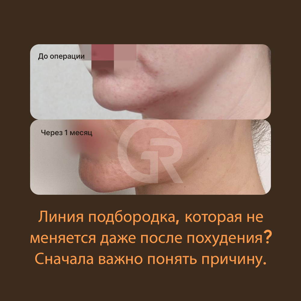 Если область под подбородком выглядит тяжелой в профиль, важно проверить, не стала ли граница между подбородком и шеей размытой.