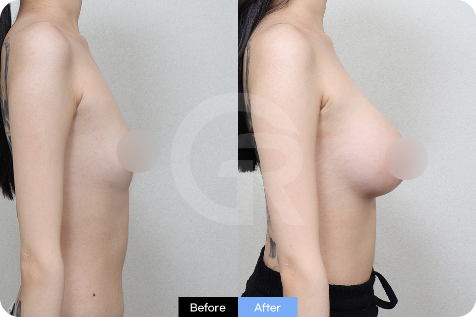Girin Plastic Surgery Korea Breast Augmentation case 05 Side