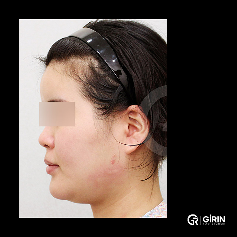 이중턱의 원인을 파악하는 것이 개선의 첫걸음입니다.绮林整形外科：安全、个性化、无恢复期的美学治疗