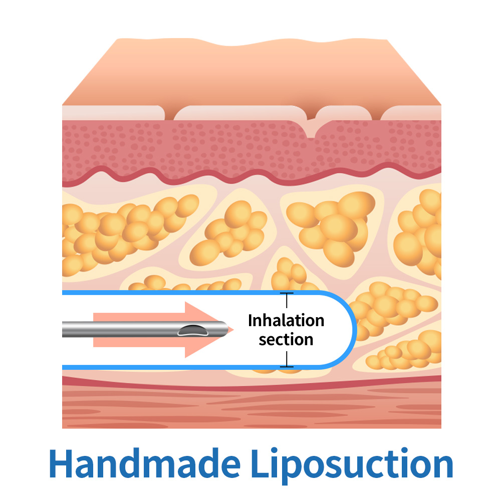 [Girin Plastic Surgery] - Liposuction and Side Effects : blog